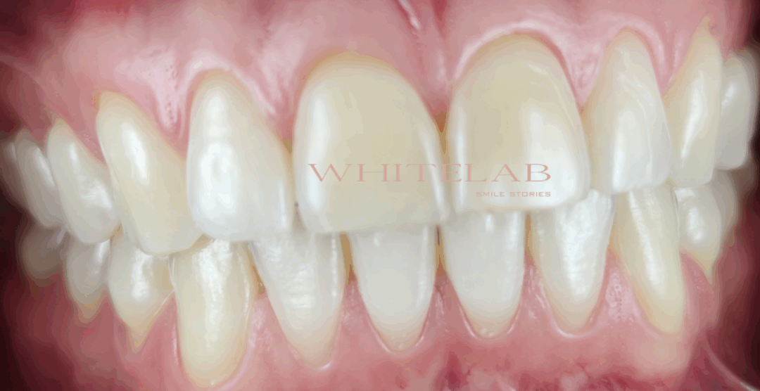 La paziente che voleva “scurire” un dente: un caso che insegna perché il risultato immediato non è sempre quello migliore