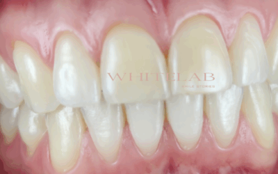 La paziente che voleva “scurire” un dente: un caso che insegna perché il risultato immediato non è sempre quello migliore